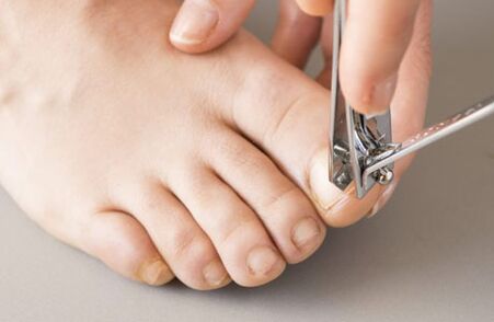 Le cause del fungo sulle unghie